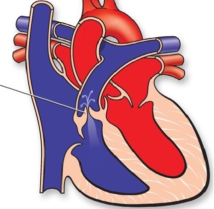 ağciyər arteriyası dəliyinin stenozu nədir?