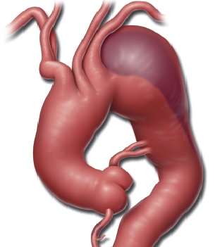 aorta qövsünün anevrizması nədir?