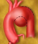Aorta qövsünün anevrizmasının səbəbləri