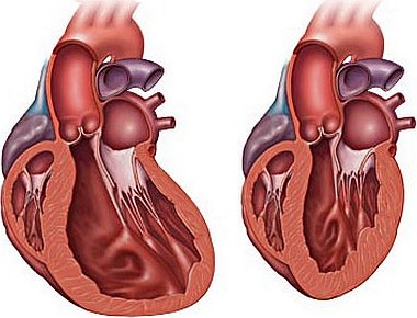 dilatasion kardiomiopatiya nədir?