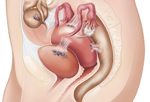 Endometriozun əlamətləri