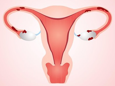 endometrioz nədir?