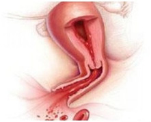 Endometriumun atipik hiperplaziyasının əlamətləri