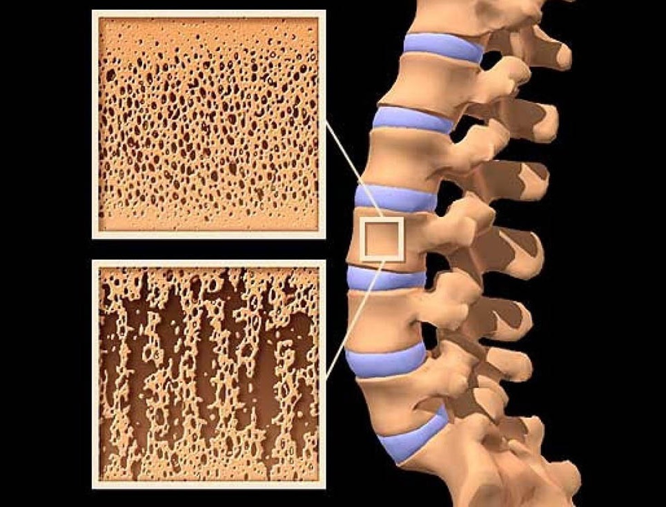 Postmenopauzal osteoporozun səbəbləri