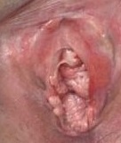 vulvanın törəmələri nədən yaranır?