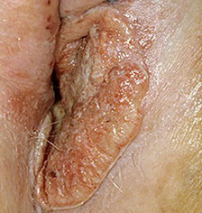 vulvanın xərçənginin səbəbləri