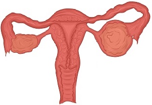 Yumurtalığın endometrioid kistasının səbəbləri