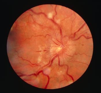 hipertenziv retinopatiya nədir?