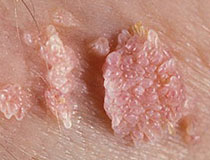 wart on foot with pus oxiuros tratamiento